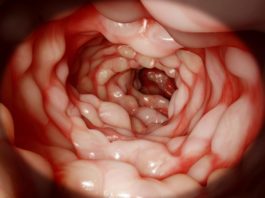 Image: Picture of a Colon. Read how to prep for a coloscopy